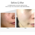 قیمت مزو کرم تسکین‌دهنده و ترمیم‌کننده سنتلا مدی‌پیلMEDI‑PEEL